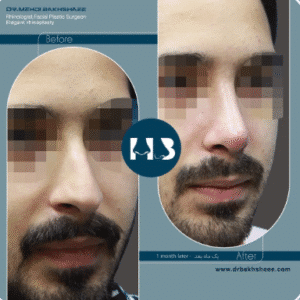 نمونه عمل بینی دکتر مهدی بخشایی