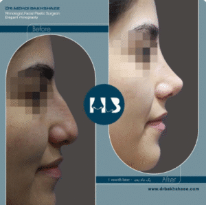 نمونه عمل بینی دکتر مهدی بخشایی