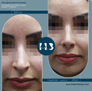 نمونه عمل بینی دکتر مهدی بخشایی