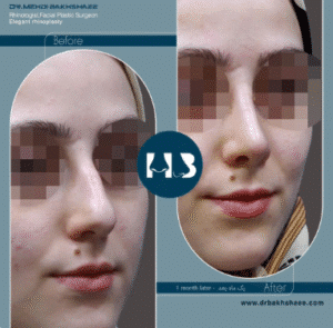 نمونه عمل بینی دکتر مهدی بخشایی