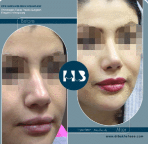 نمونه عمل بینی دکتر مهدی بخشایی