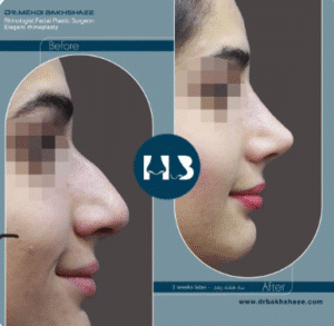 نمونه عمل بینی دکتر مهدی بخشایی