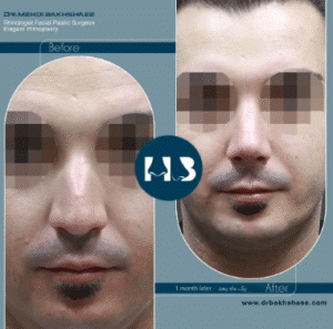 نمونه عمل بینی دکتر مهدی بخشایی