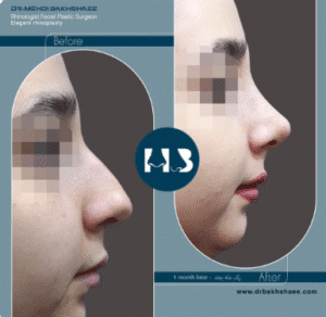 نمونه عمل بینی دکتر مهدی بخشایی