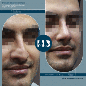 نمونه عمل بینی دکتر مهدی بخشایی