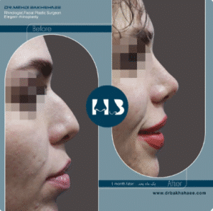 نمونه عمل بینی دکتر مهدی بخشایی