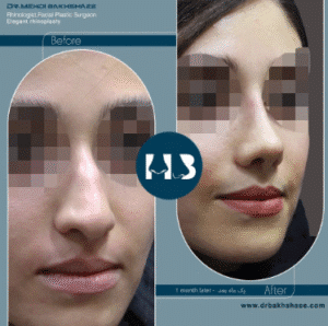 نمونه عمل بینی دکتر مهدی بخشایی