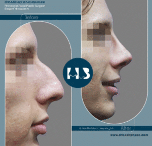 نمونه عمل بینی دکتر مهدی بخشایی