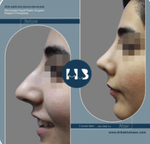 نمونه عمل بینی دکتر مهدی بخشایی