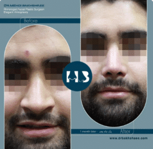 نمونه عمل بینی دکتر مهدی بخشایی