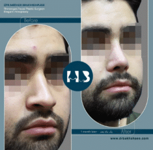 نمونه عمل بینی دکتر مهدی بخشایی