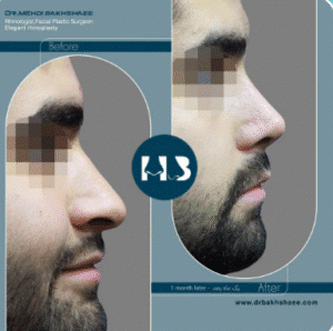 نمونه عمل بینی دکتر مهدی بخشایی