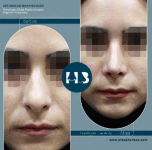 نمونه عمل بینی دکتر مهدی بخشایی