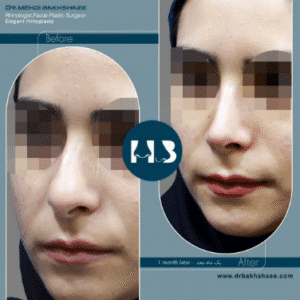 نمونه عمل بینی دکتر مهدی بخشایی