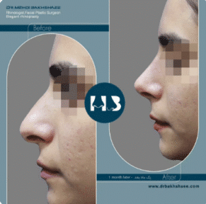 نمونه عمل بینی دکتر مهدی بخشایی