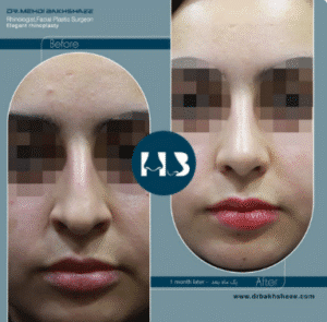 نمونه عمل بینی دکتر مهدی بخشایی