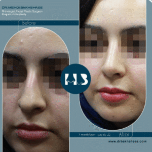 نمونه عمل بینی دکتر مهدی بخشایی