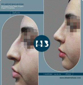 نمونه عمل بینی دکتر مهدی بخشایی