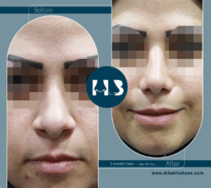 نمونه عمل بینی دکتر مهدی بخشایی