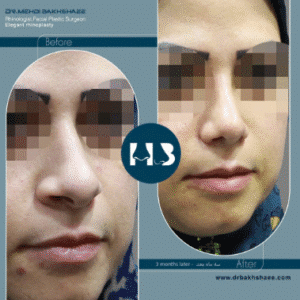 نمونه عمل بینی دکتر مهدی بخشایی