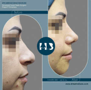 نمونه عمل بینی دکتر مهدی بخشایی