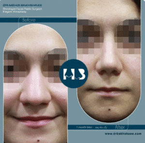 نمونه عمل بینی دکتر مهدی بخشایی