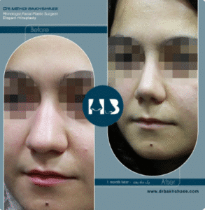 نمونه عمل بینی دکتر مهدی بخشایی