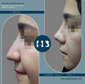 نمونه عمل بینی دکتر مهدی بخشایی