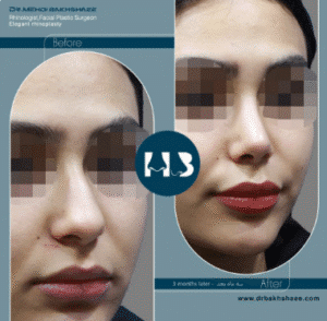 نمونه عمل بینی دکتر مهدی بخشایی
