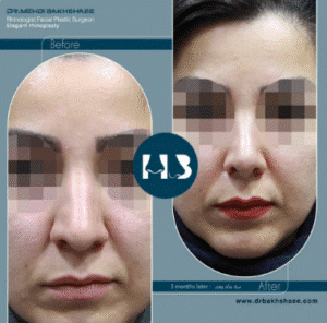 نمونه عمل بینی دکتر مهدی بخشایی