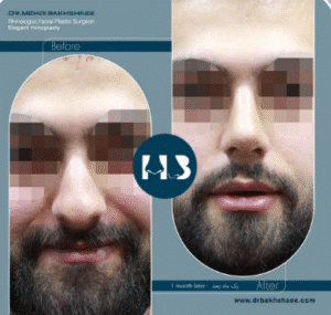 نمونه عمل بینی دکتر مهدی بخشایی