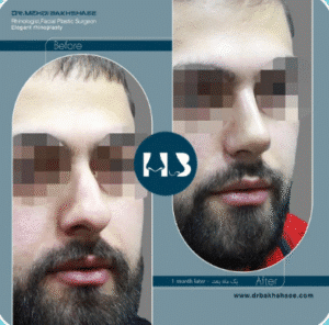 نمونه عمل بینی دکتر مهدی بخشایی