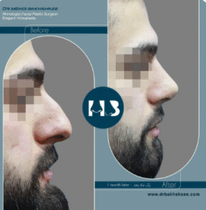 نمونه عمل بینی دکتر مهدی بخشایی