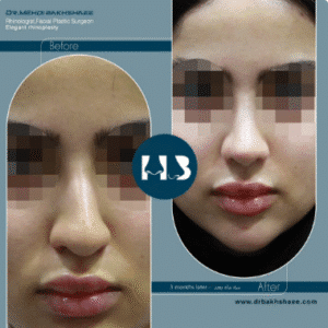 نمونه عمل بینی دکتر مهدی بخشایی