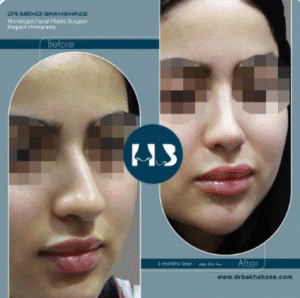 نمونه عمل بینی دکتر مهدی بخشایی