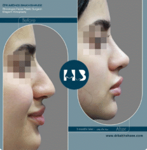 نمونه عمل بینی دکتر مهدی بخشایی