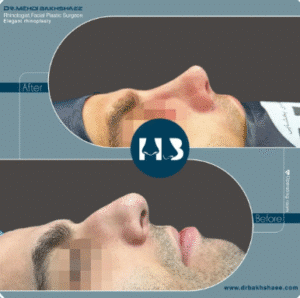 نمونه عمل بینی دکتر مهدی بخشایی