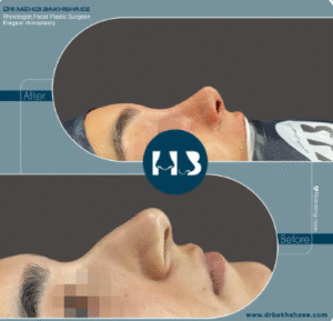 نمونه عمل بینی دکتر مهدی بخشایی