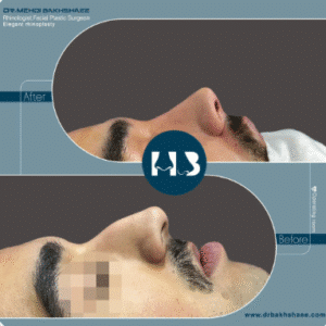 نمونه عمل بینی دکتر مهدی بخشایی