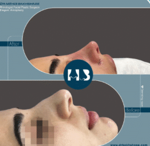 نمونه عمل بینی دکتر مهدی بخشایی