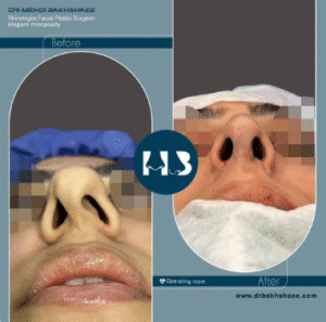 نمونه عمل بینی دکتر مهدی بخشایی