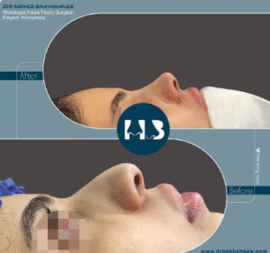 نمونه عمل بینی دکتر مهدی بخشایی