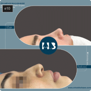 نمونه عمل بینی دکتر مهدی بخشایی