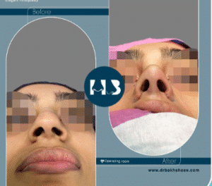 نمونه عمل بینی دکتر مهدی بخشایی