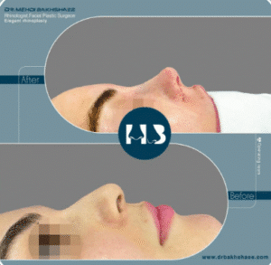 نمونه عمل بینی دکتر مهدی بخشایی