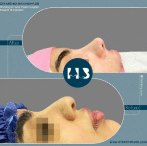 نمونه عمل بینی دکتر مهدی بخشایی