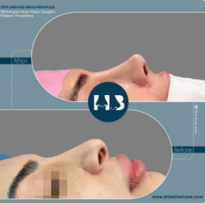 نمونه عمل بینی دکتر مهدی بخشایی