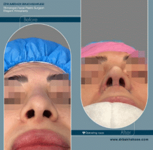 نمونه عمل بینی دکتر مهدی بخشایی