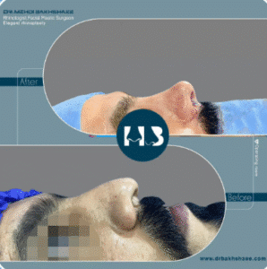 نمونه عمل بینی دکتر مهدی بخشایی