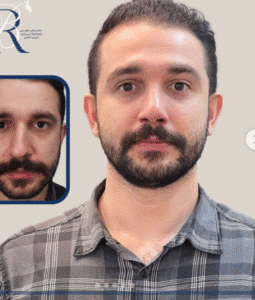 نمونه عمل بینی دکتر بشیر رسولیان